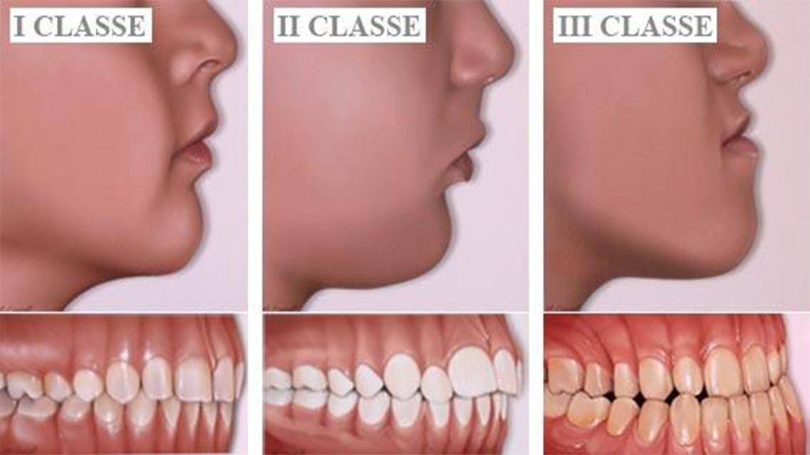 Principali tipi di malocclusioni - Studio Dentistico Macca